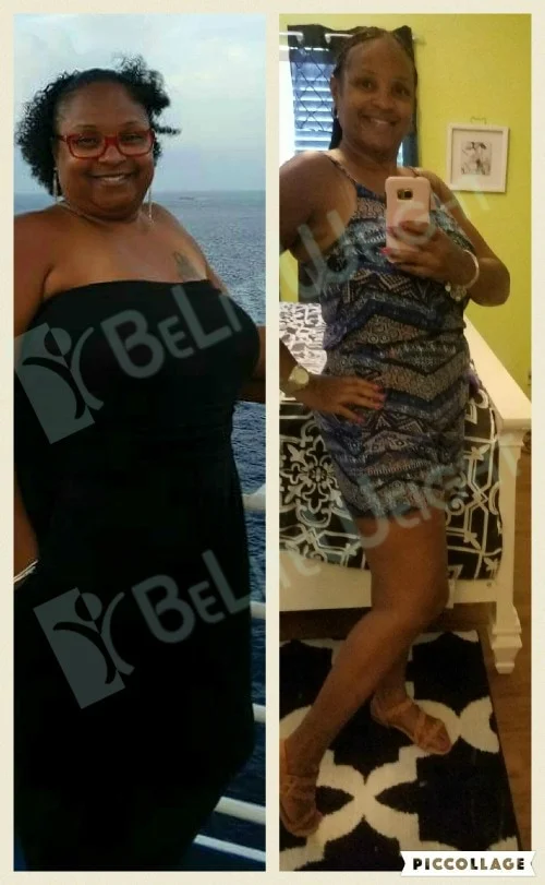 weight loss surgery before and after 6 months vsg gastric sleeve bypass lap band revision